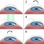 How laser used in eye surgery